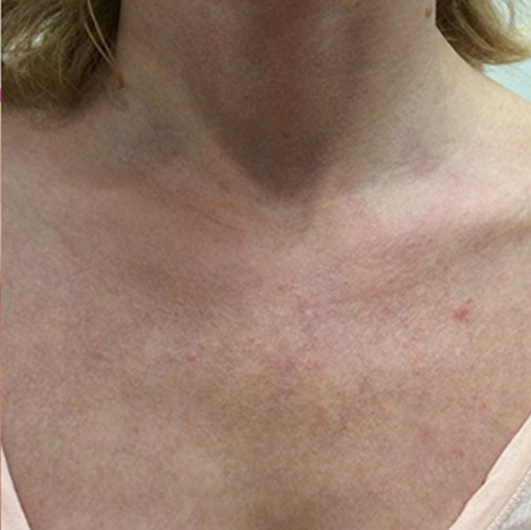 Excel V for Chest Redness | Seattle, Washington | Advanced Dermatology ...