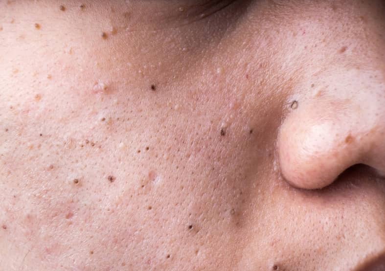 What Actually Are Blackheads Advanced Dermatology And Laser 