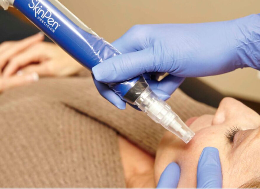 SkinPen microneedling procedure